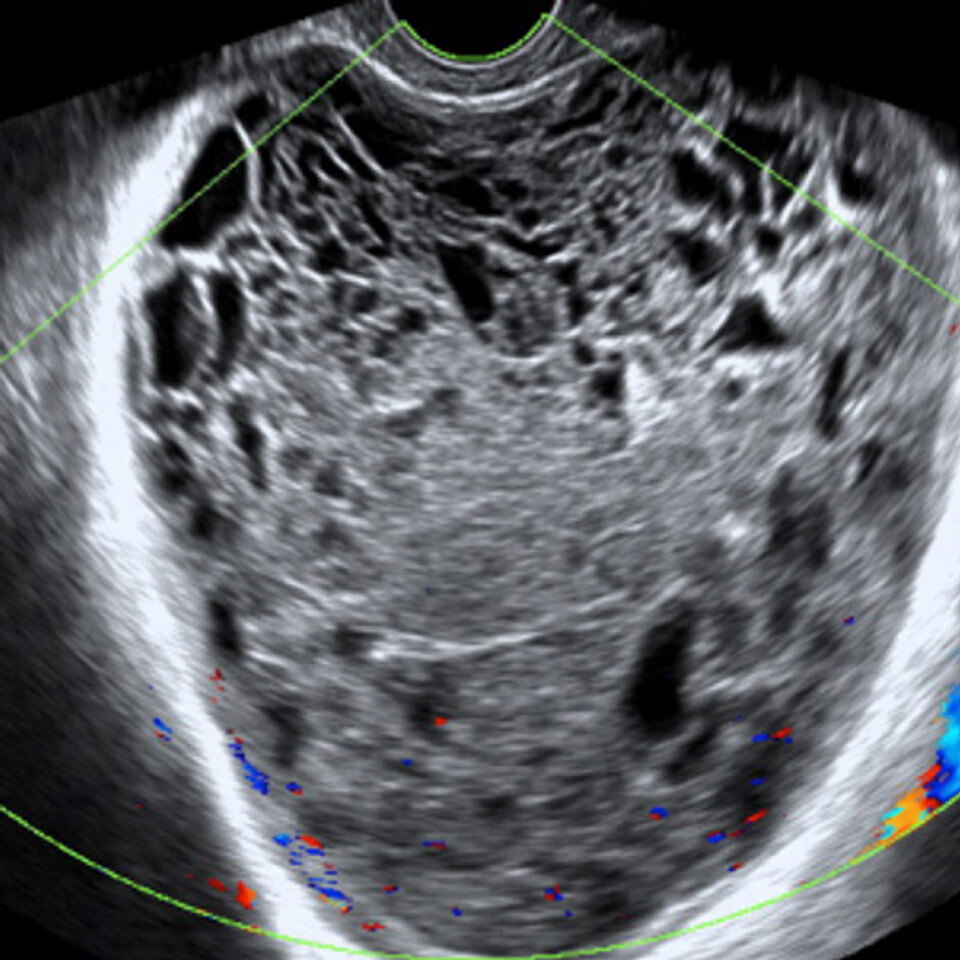 Ultrasound Nonmalignant Adnexal Conditions