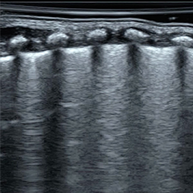 Pediatric Lung Sonography