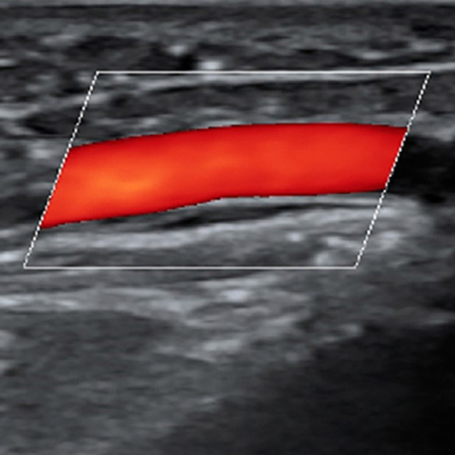 Advanced predialysis ultrasound education image