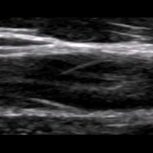 arm_venous_ultrasound__11795
