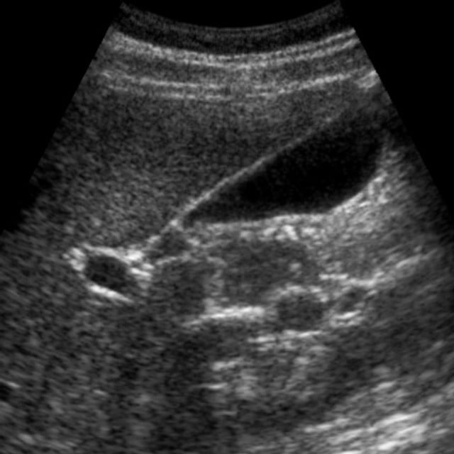 Ultrasound image of the biliary tree used in ultrasound education