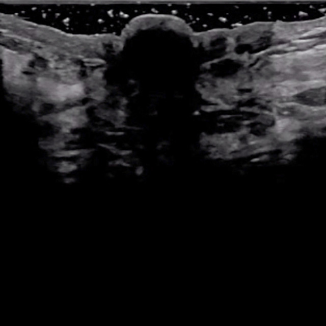 Breast