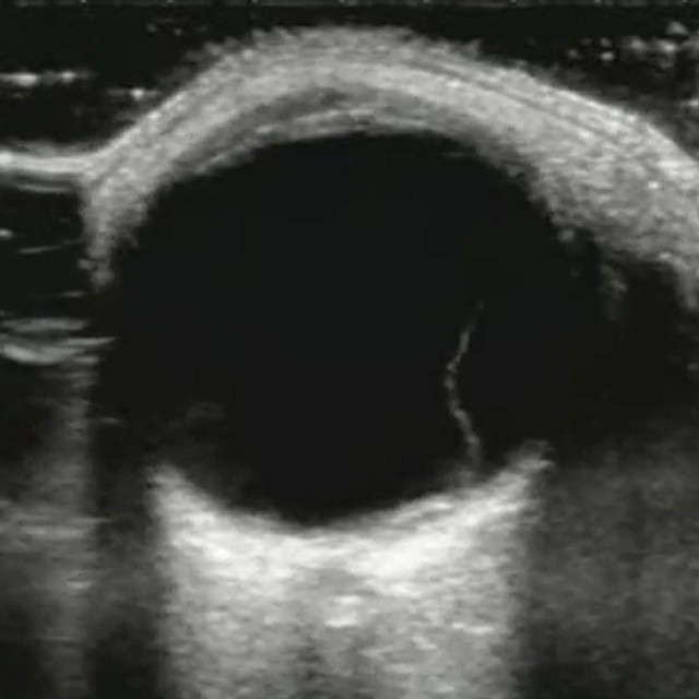 Ocular