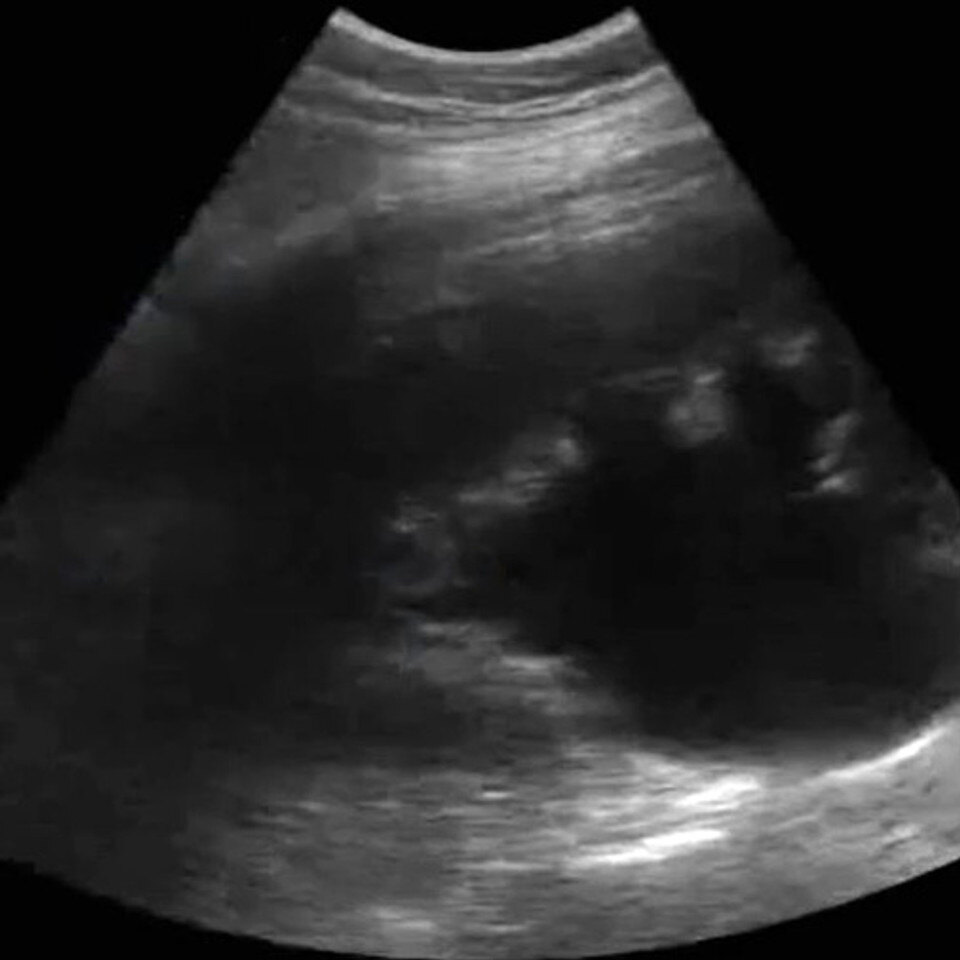 Renal