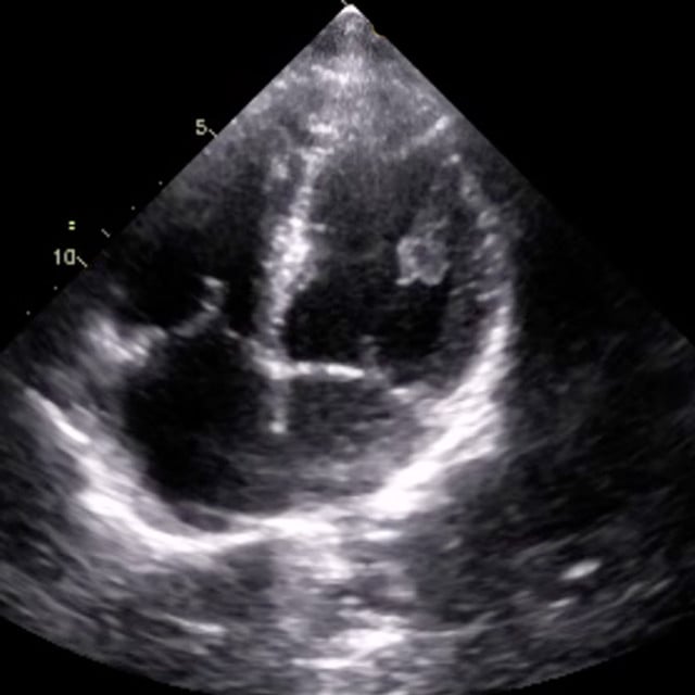 An ultrasound scan of the heart used in cardiac ultrasound training 