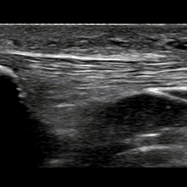 knee_ultrasound__21914-2