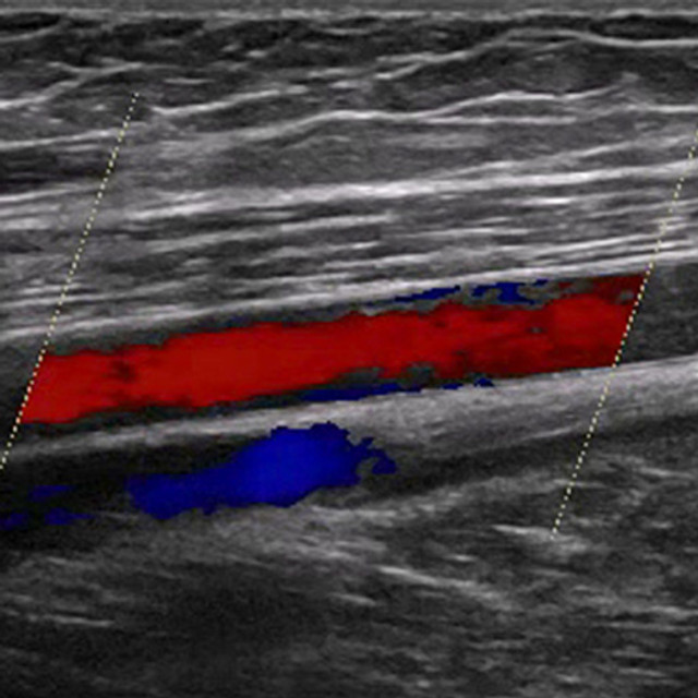 Leg arterial ultrasound education image