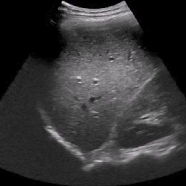 Ultrasound of the liver used in point of care ultrasound training