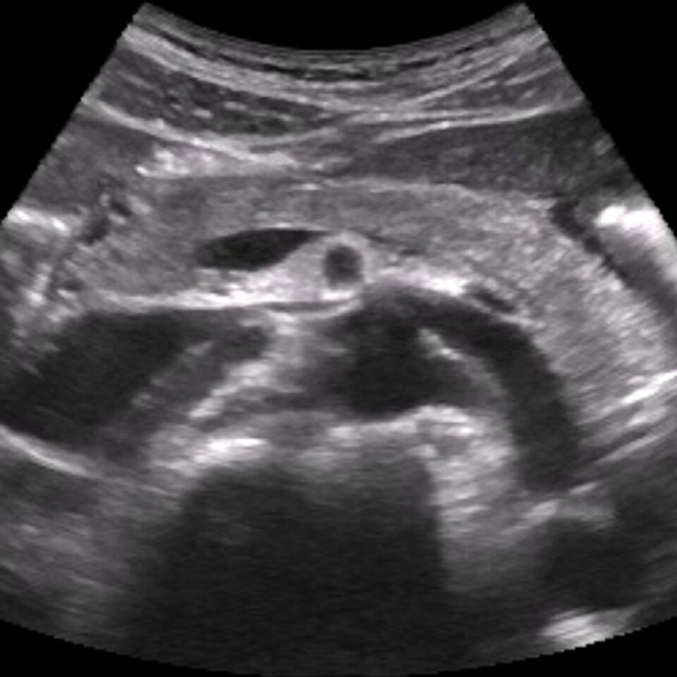 Pancreas