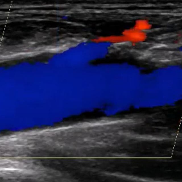 Procedure femoral ultrasound scan