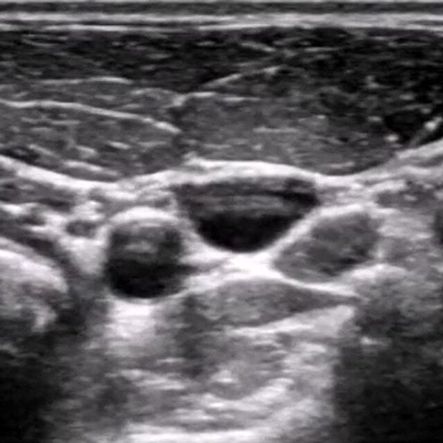 procedure_ij_ultrasound__58698