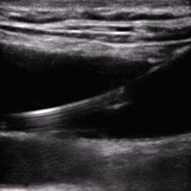 procedure_intro_ultrasound__85464