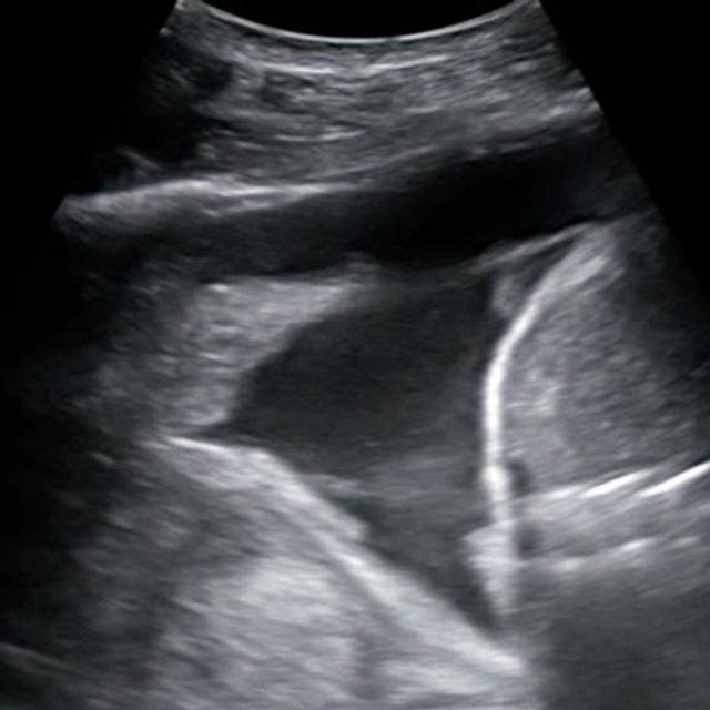 Ultrasound-Guided Thoracentesis Procedure