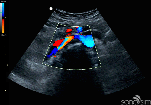 Renal arteries doppler image found in SonoSim ultrasound training cases