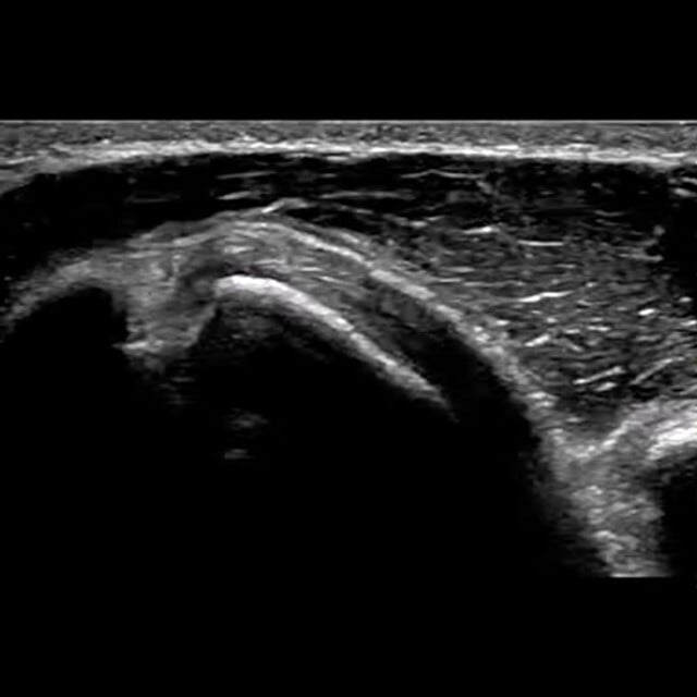 shoulder_ultrasound__94918