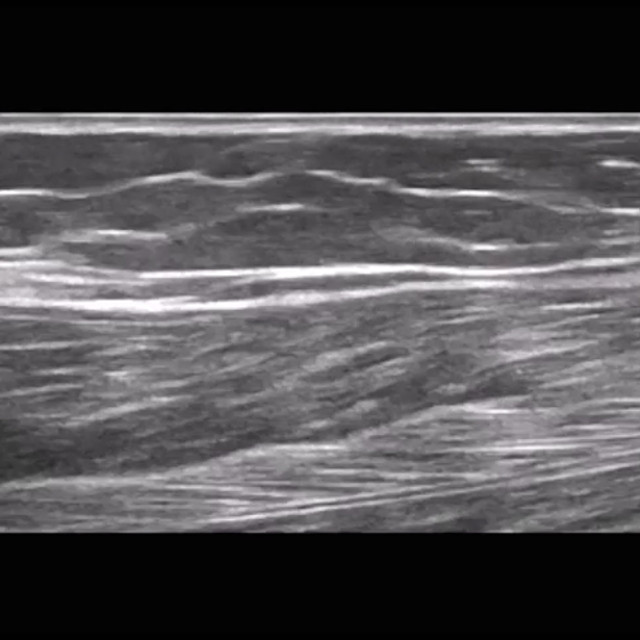 softtissue_ultrasound__00888