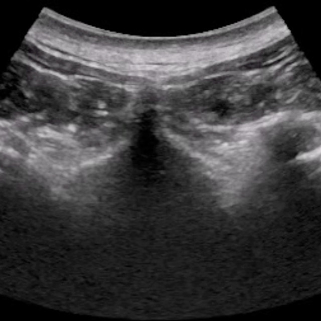 spine_ultrasound__72121