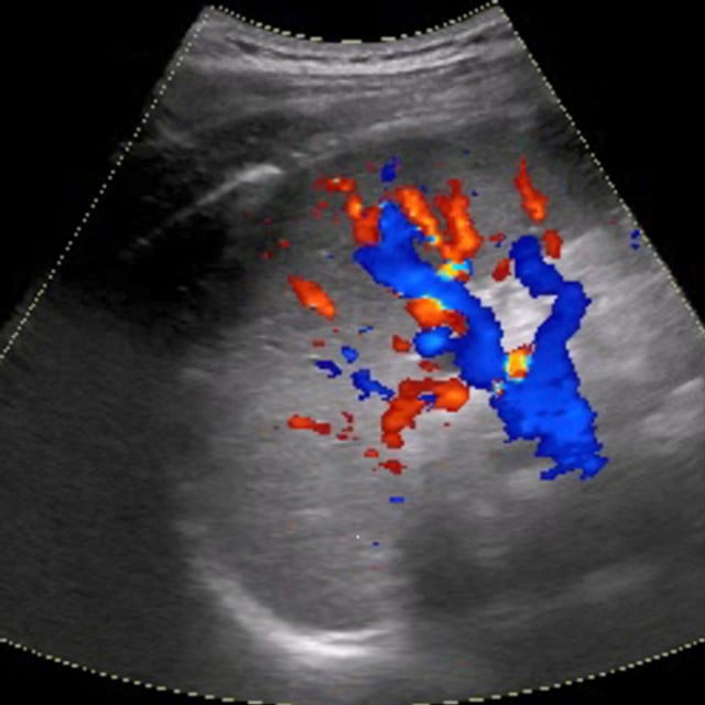 Ultrasound training image of the spleen
